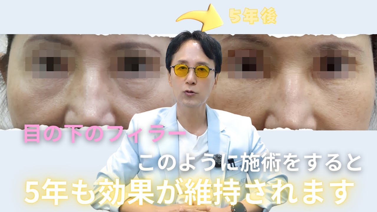 手術なしで目の下のクマとたるみを同時に改善！｜目の下フィラー