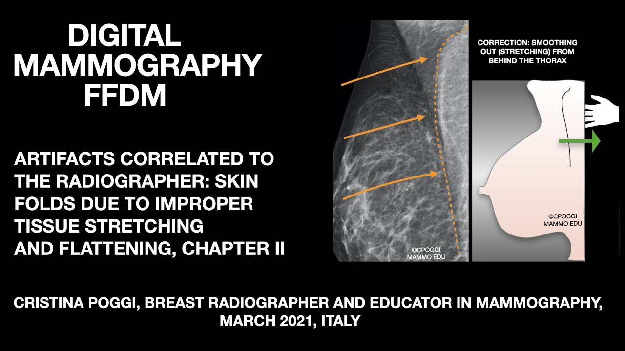 THE ARTIFACTS CORRELATED TO THE RADIOGRAPHER IN DIGITAL MAMMOGRAPHY: SKIN FOLDS, VIDEO 2