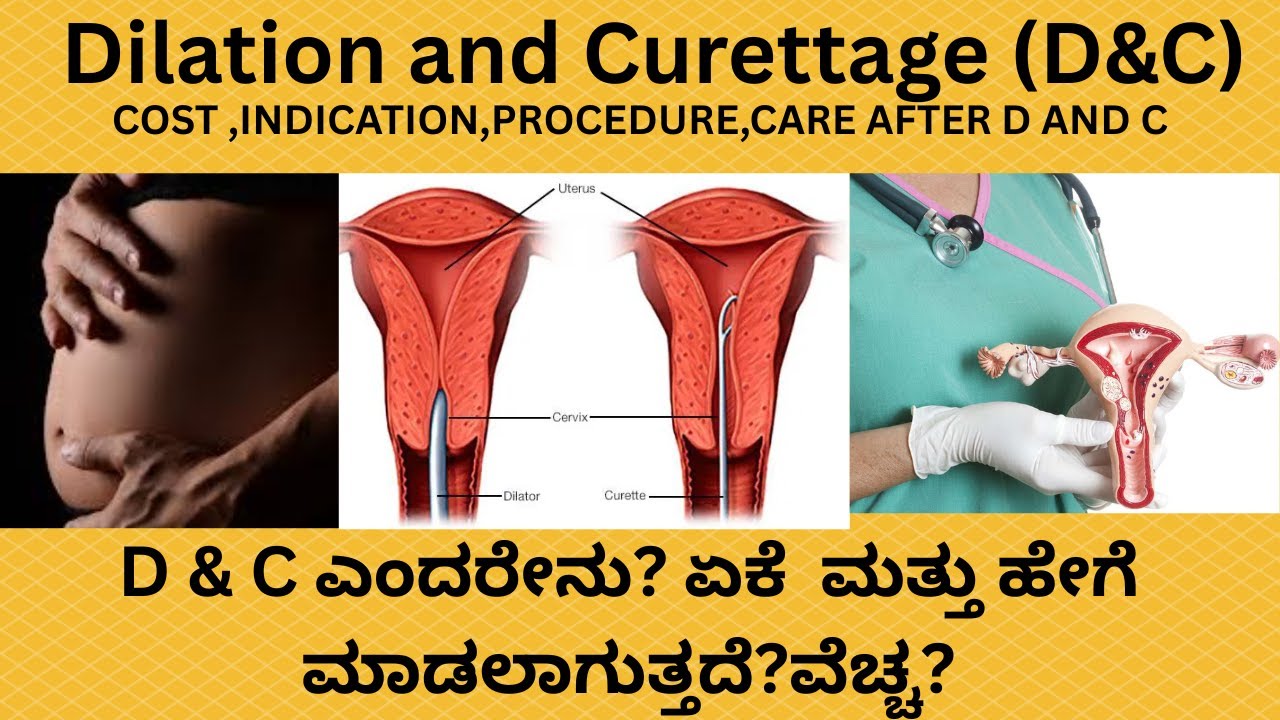 D AND C (DILATATION AND CURRETAGE) IN KANNADA.WHEN IS IT DONE,SIDE EFFECTS,COST EXPLAINED IN KANNADA