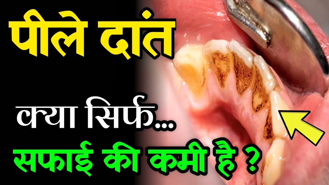 सिर्फ ब्रश नहीं… दांतों का रंग बता रहा है आपकी अंदरूनी हालत