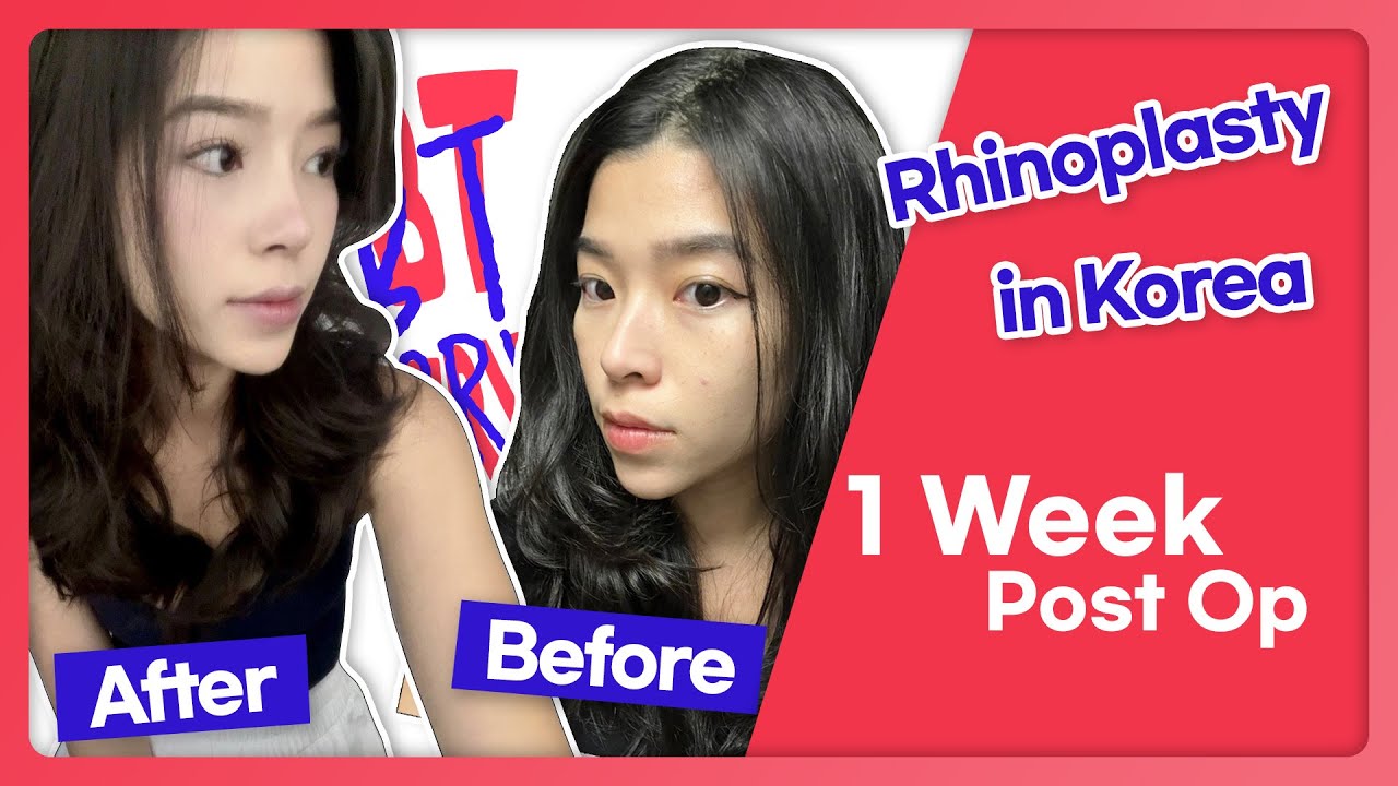 Rhinoplasty before & after Vlog, BT Plastic Surgery with Doctor Lee Seung Ho