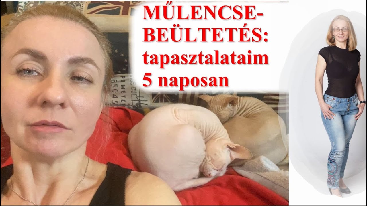 Műlencse műt&eacute;t ut&aacute;n 5 nappal - f&eacute;nyek, szemcseppek, l&aacute;t&aacute;s&eacute;lm&eacute;ny