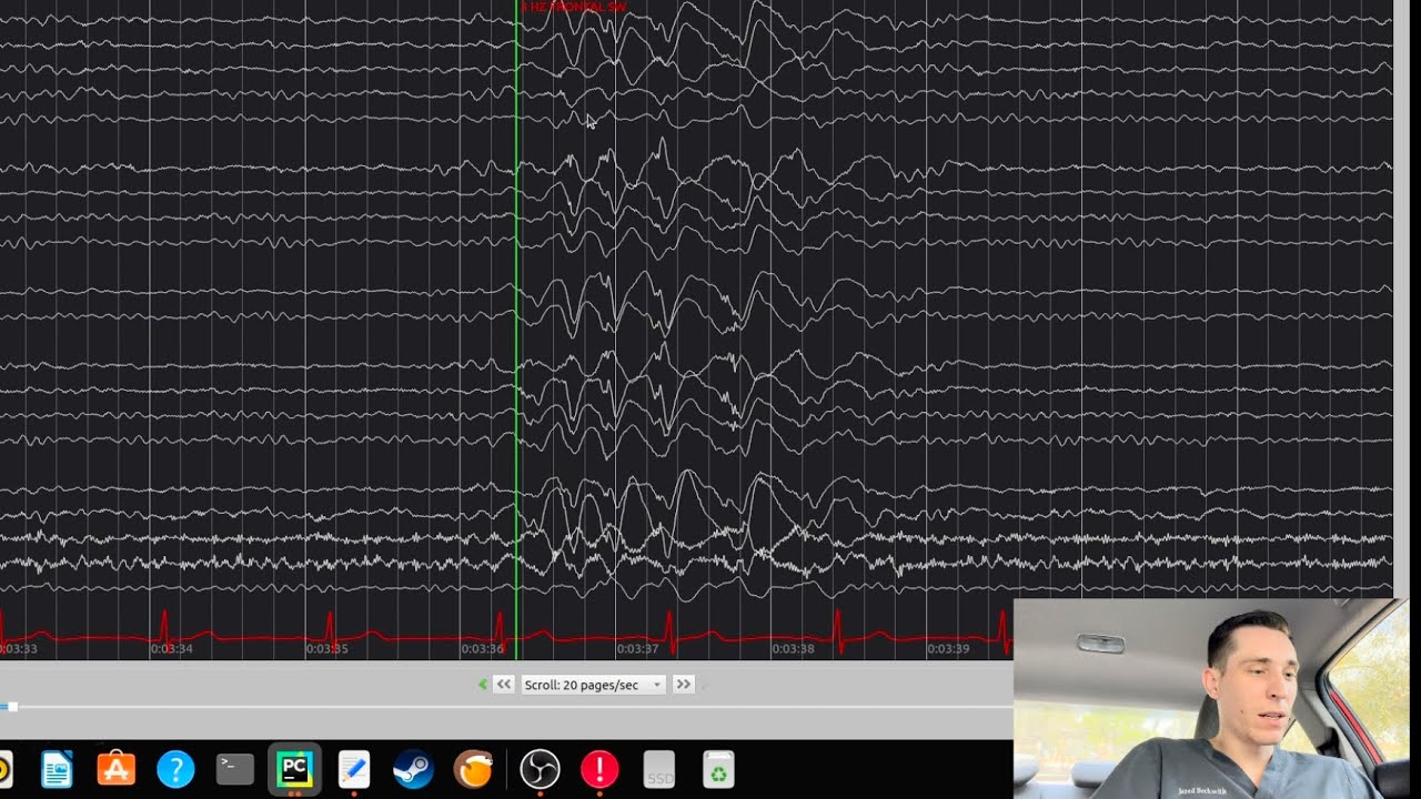 EEG with Frontal Spike & Wave Discharges
