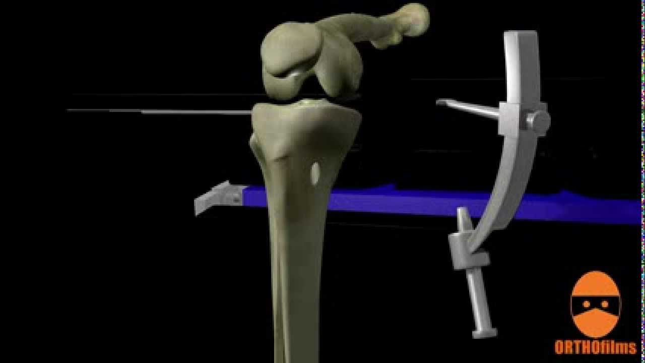 ACL Reconstruction Surgery