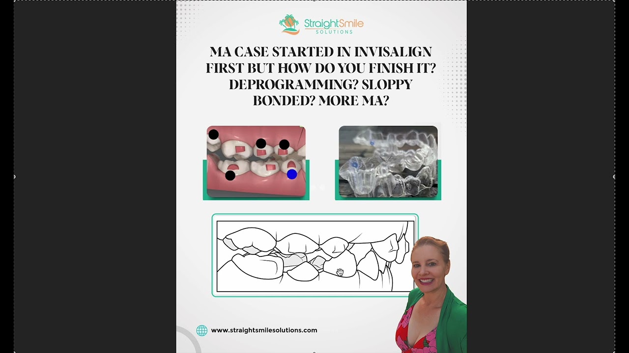 Лучший способ исправить Invisalign с помощью MA POB? : Мини-элайнеры? Неаккуратно приклеенные рет...