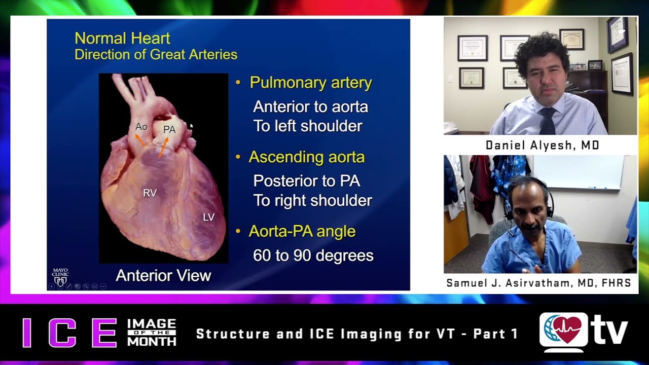 ICE Image of the Month (Apr 2023) Part I: ICE and Ventricular Arrhythmias Overview