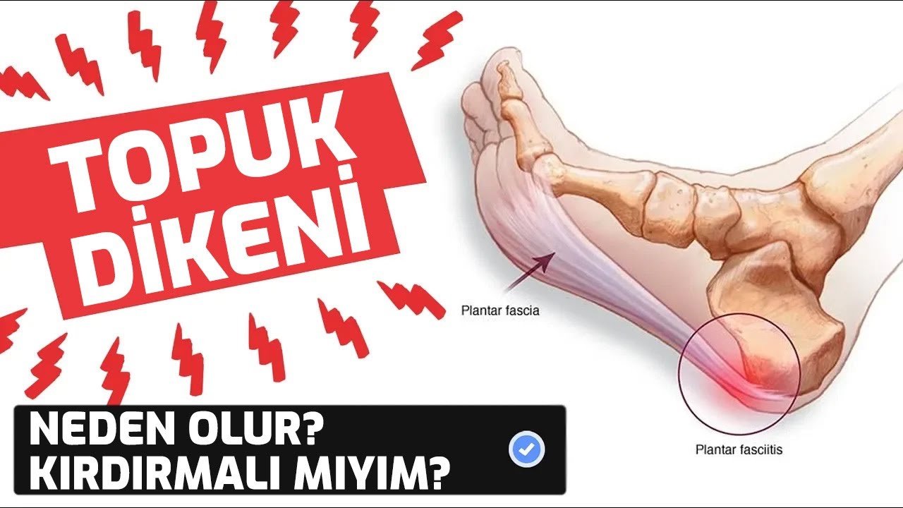 #Topuk Dikeninin Kırdırılması Çözüm mü? Neye Dikkat Etmeli? Topuk Dikeni
