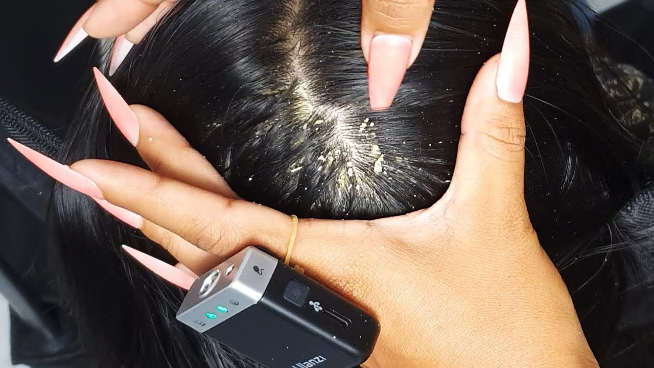 Ultimate Itchy Scalp Session ASMR 💆‍♀️✨ | Heavy Flake Detail & Slow Scratching #VF0001