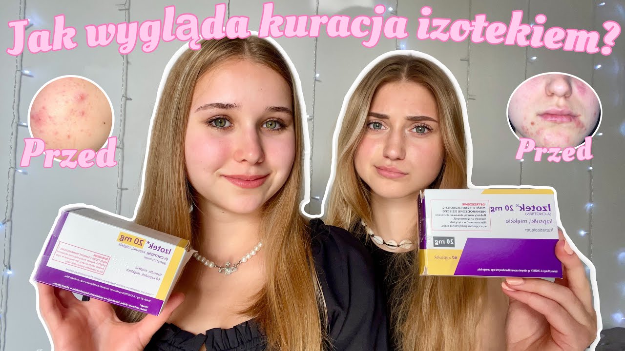 JAK WYLECZYŁYŚMY TRĄDZIK? | SKUTKI UBOCZNE, EFEKTY, KOSMETYKI | IZOTEK