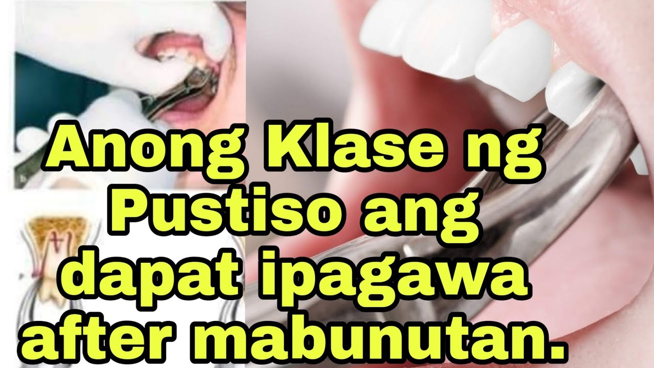 Anong Klase ng Pustiso ang dapat ipagawa after mabunutan Ordinary/Acrylic, Flexible at Peek dentures