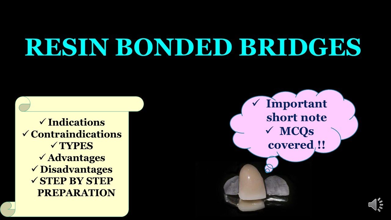 RESIN BONDED BRIDGES / CONSERVATIVE BRIDGES / MARYLAND BRIDGE