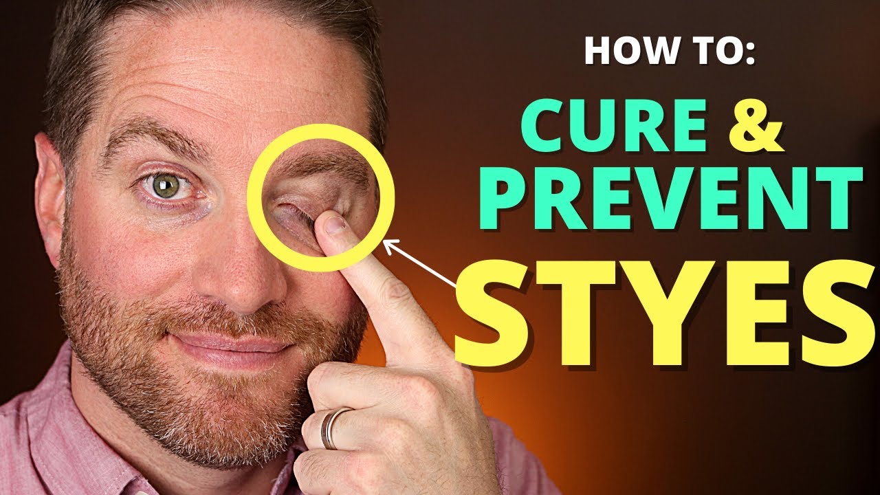 How To CURE And PREVENT STYES: Get Rid Of A Hordeolum (stye) And Chalazion Fast!