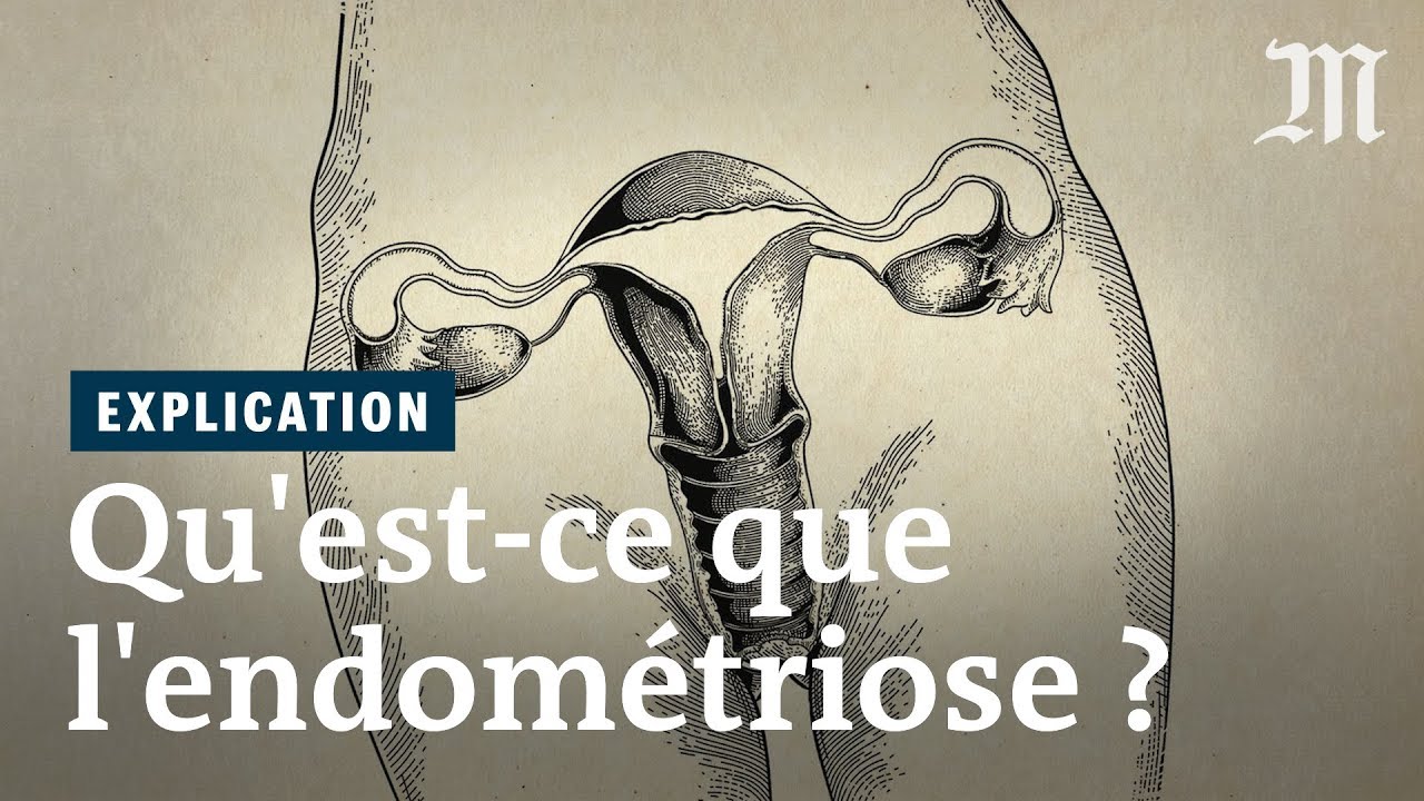 Qu&rsquo;est-ce que l&rsquo;endom&eacute;triose ?