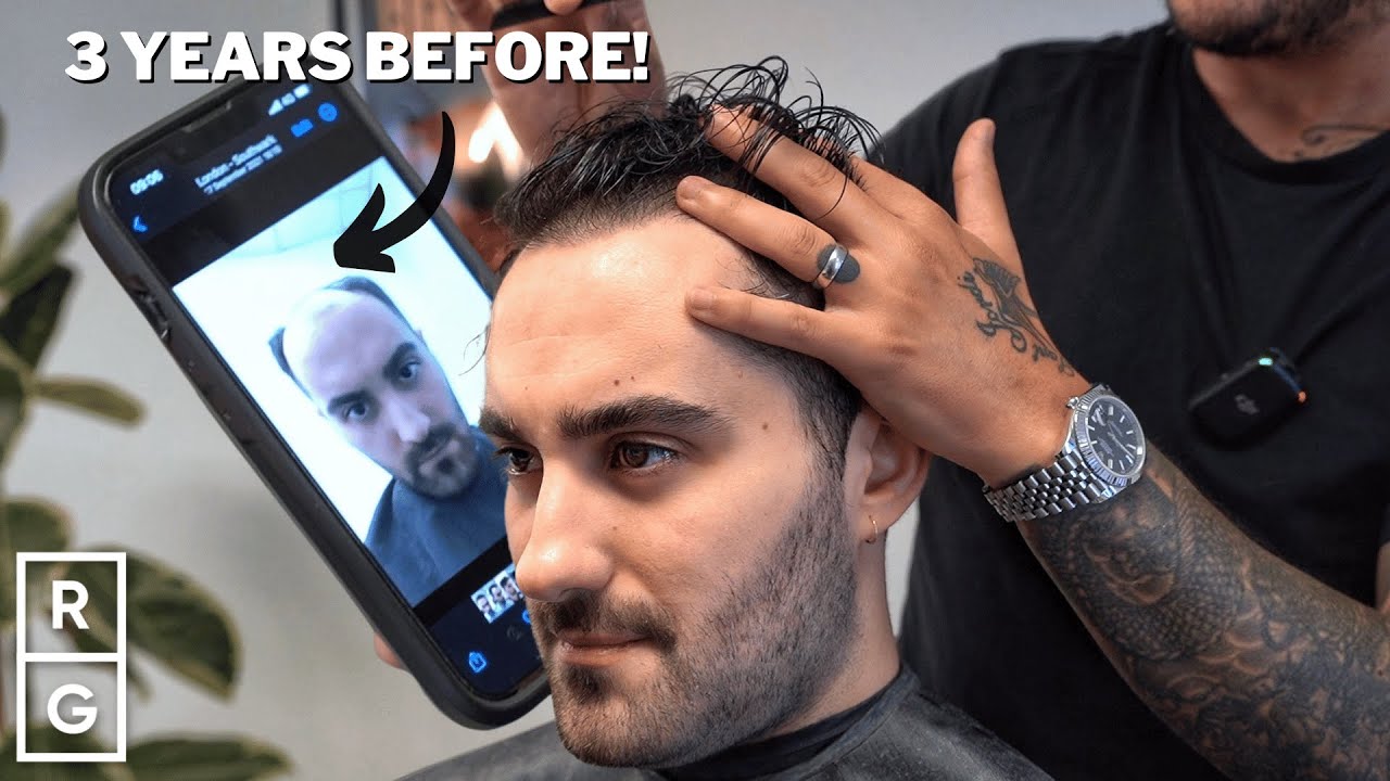 He Tried EVERY Treatment for HAIR LOSS (Transplant, Medication, Hair System) | Talking Hair Loss S2