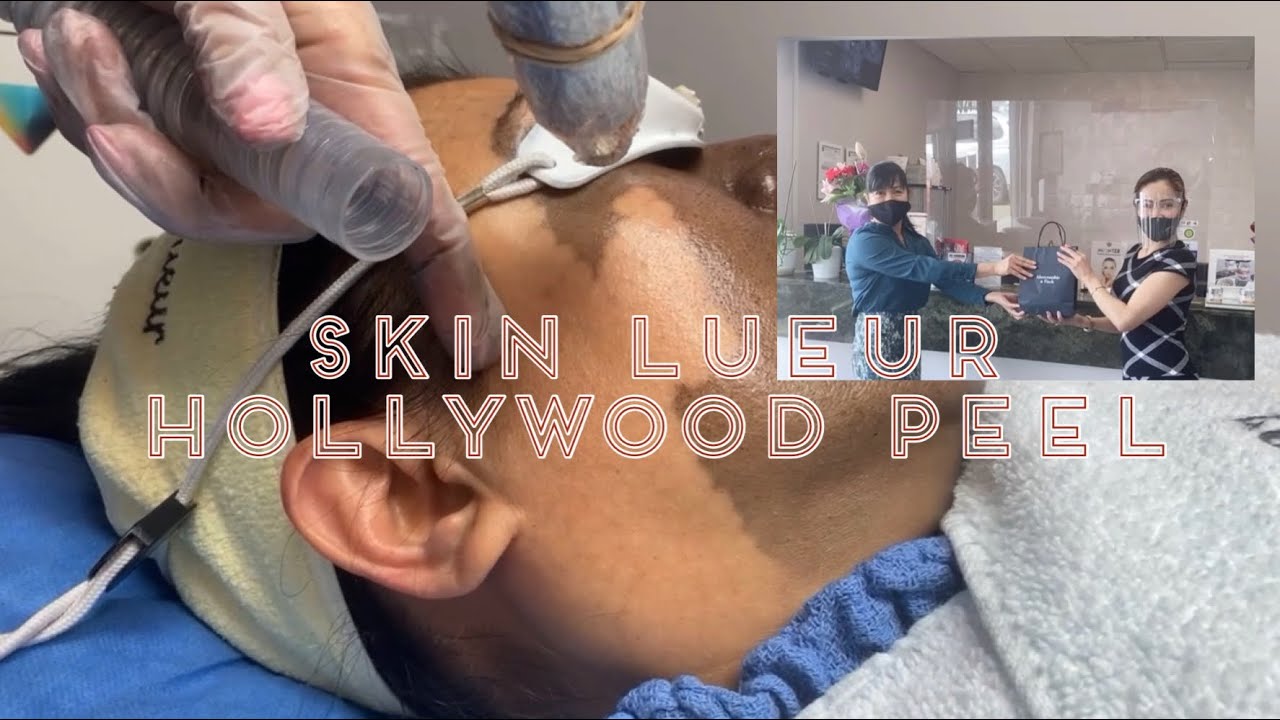 How to look younger |Skin Lueur Hollywood Peel | Carbon Laser facial| Canada | 