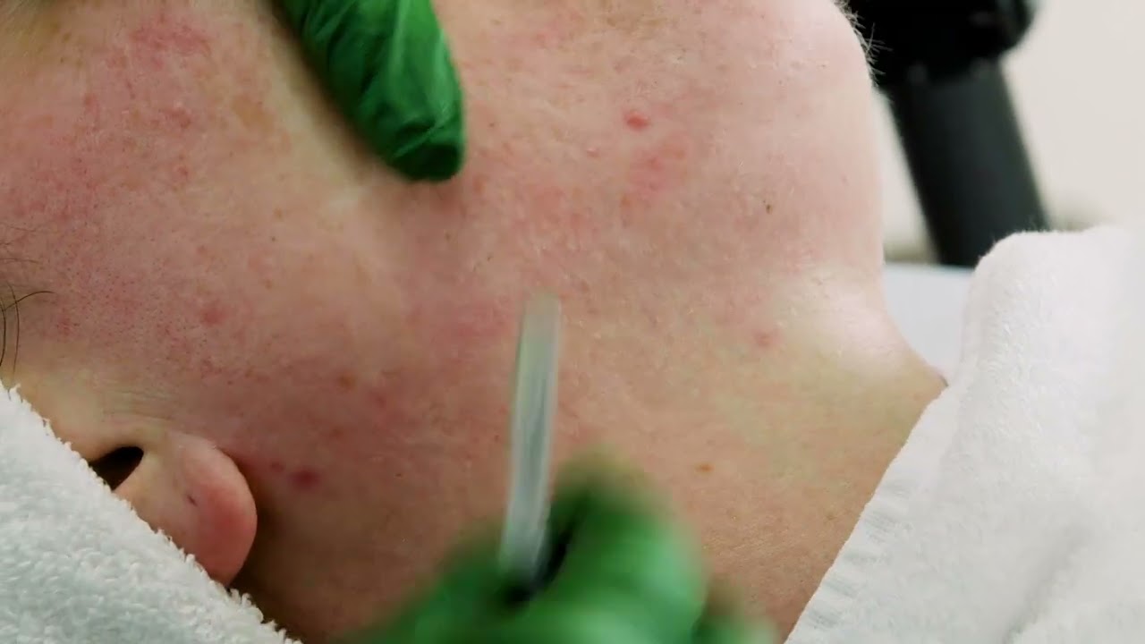 Dermaplaning Demonstration