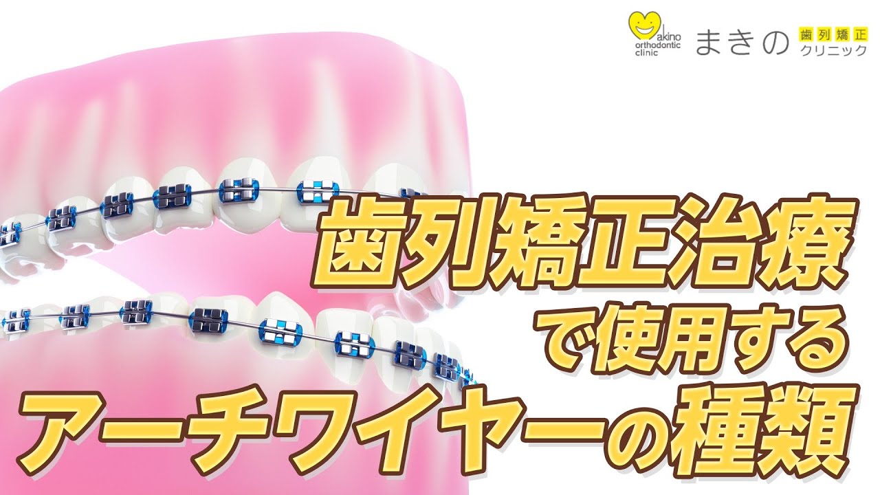 歯列矯正治療で使用するアーチワイヤーの種類【材質・形・色】