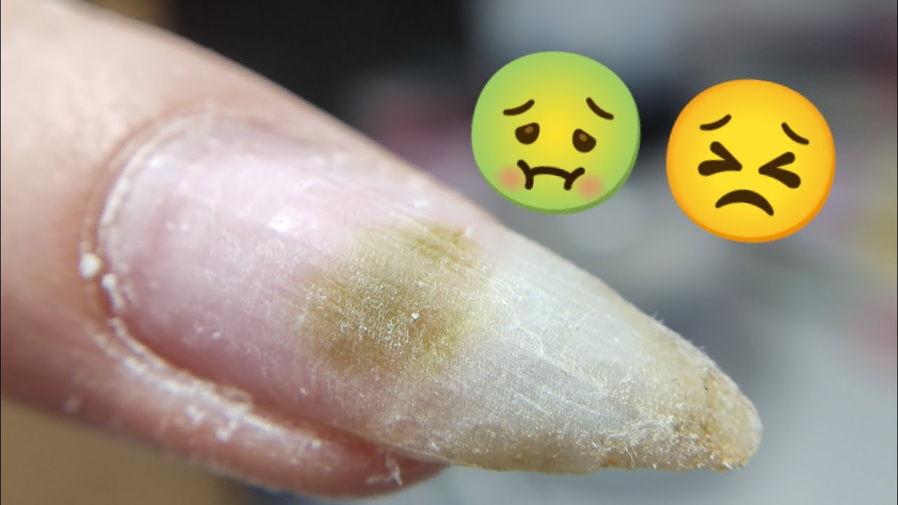 ПЛЕСЕНЬ 😣 на ногте. ОПАСНО ЛИ? ГЕЛЕВАЯ КОРРЕКЦИЯ НОГТЕЙ