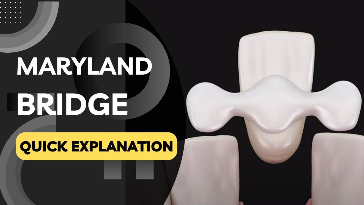What is a Maryland Bridge? Quickly Explained in a Few Seconds!