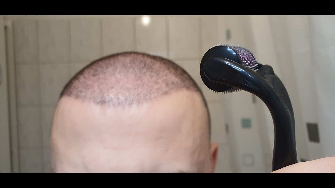 Minoxidil & Dermarolling Results 6 MONTHS | Month by Month Progress