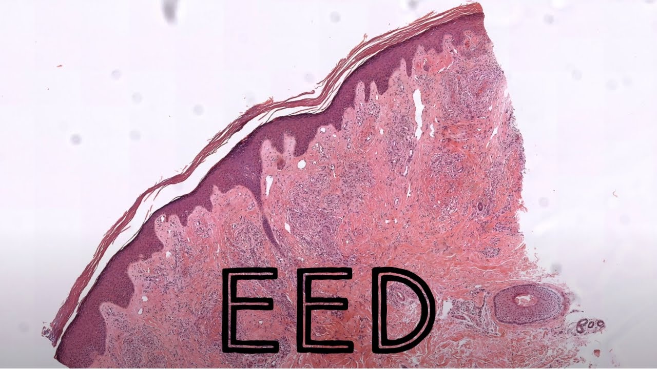 EED (Erythema elevatum diutinum) fibrosing vasculitis (dermpath dermatology dermatopathology)
