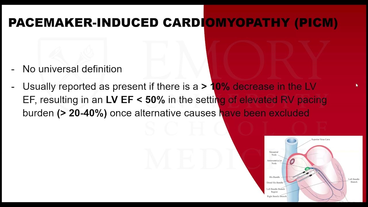 Should All Patients Undergoing Pacemaker Implantation Undergo Conduction System Pacing?