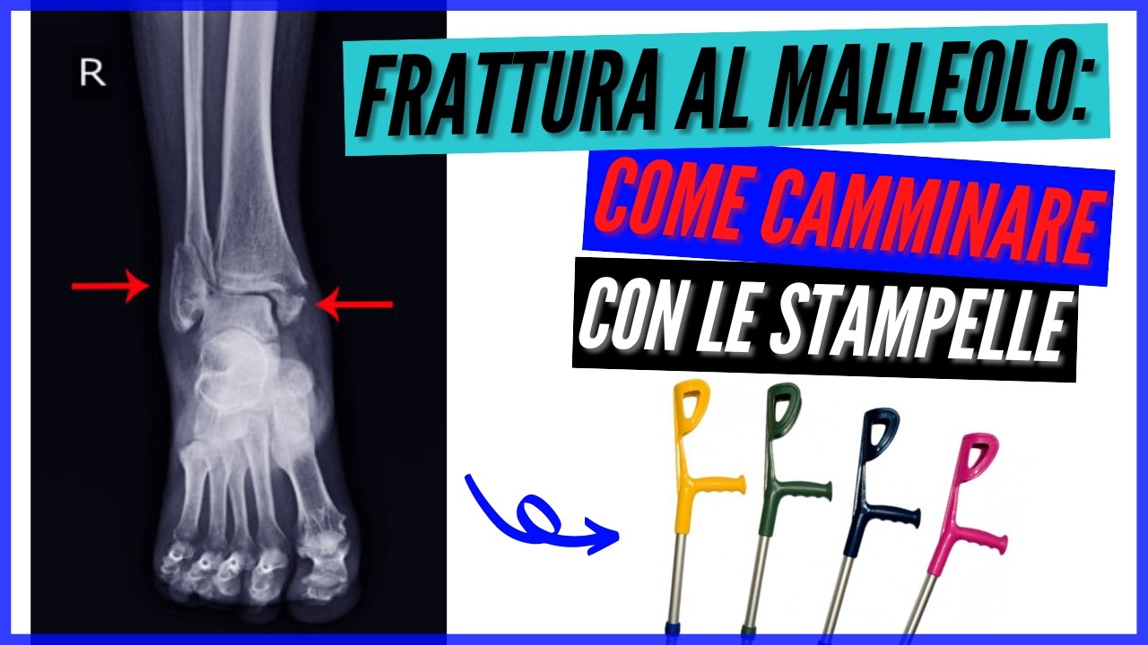Frattura al malleolo come camminare con le stampelle