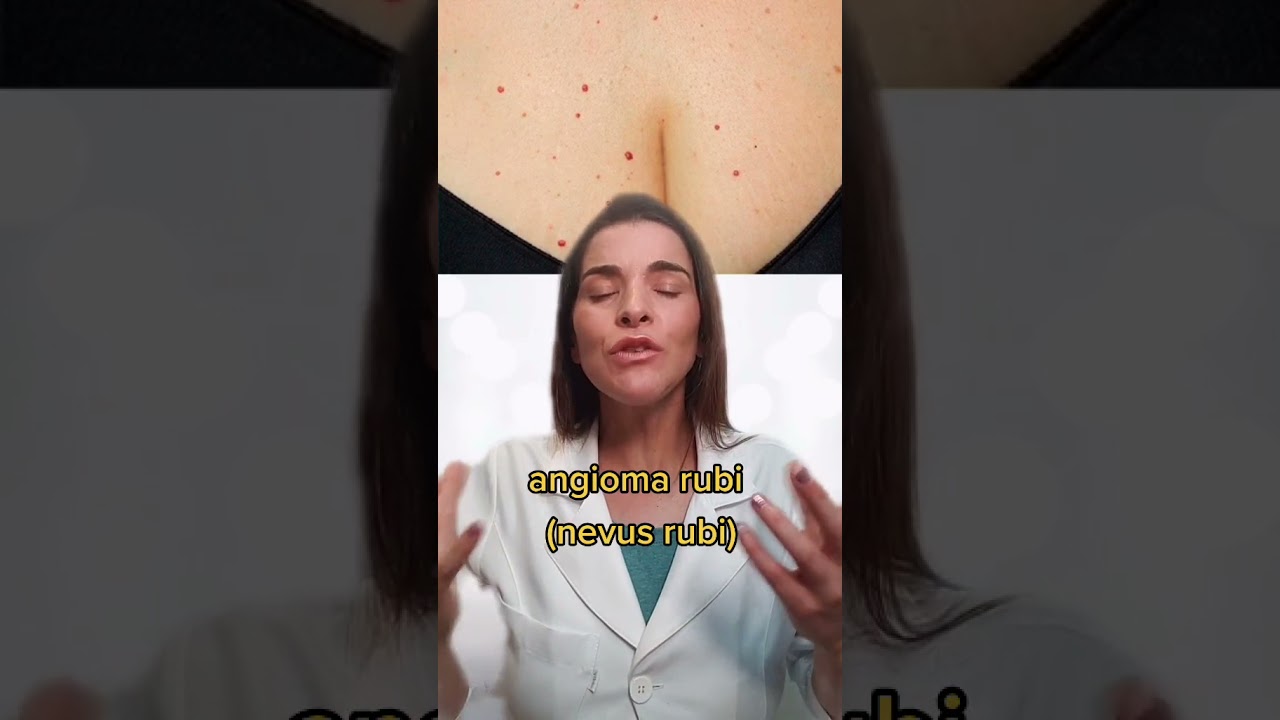 Angioma Rubi (Nevus Rubi) #Shorts