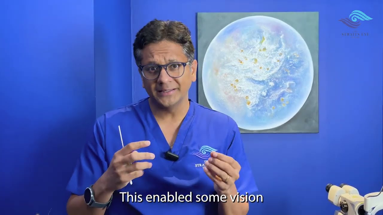 WHAT IS CATARACT SURGERY? The Straits Eye Centre shares interesting facts about the cataract surgery
