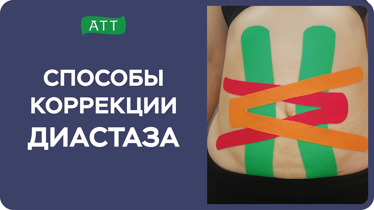 Диастаз прямых мышц живота. Эстетическое тейпирование. Упражнения при диастазе. Мастер класс.