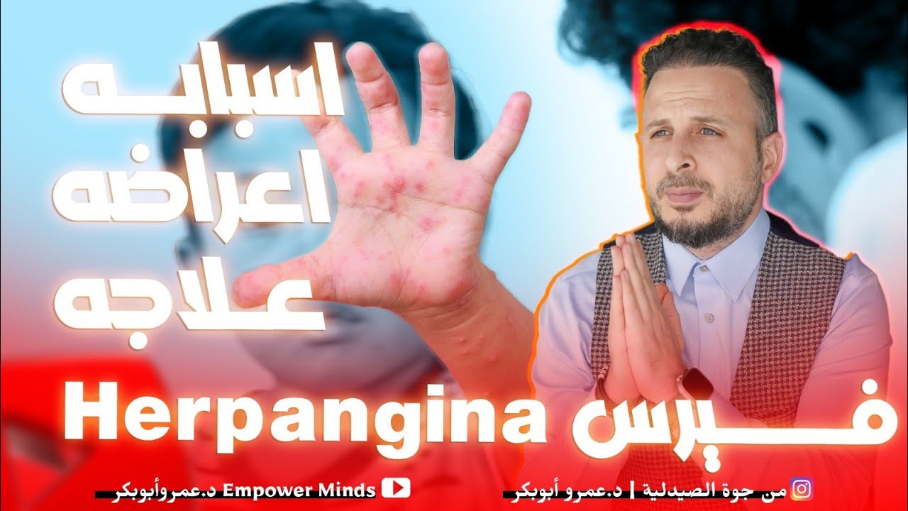 فيروس الحلا الخناقي المنتشر بين الاطفال الأسباب والأعراض والعلاج  Herpangina