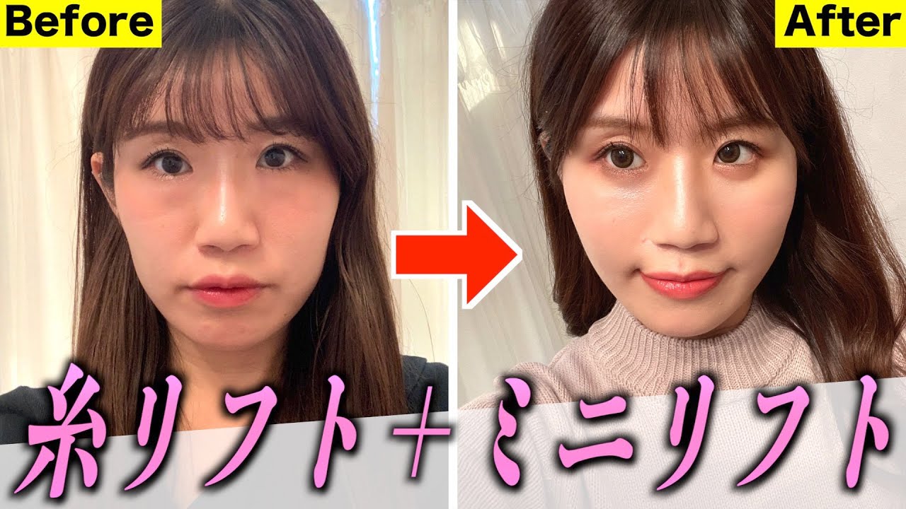 【整形】糸リフト&ミニリフトのカウンセリング→ダウンタイム→ビフォーアフターまでを公開します。