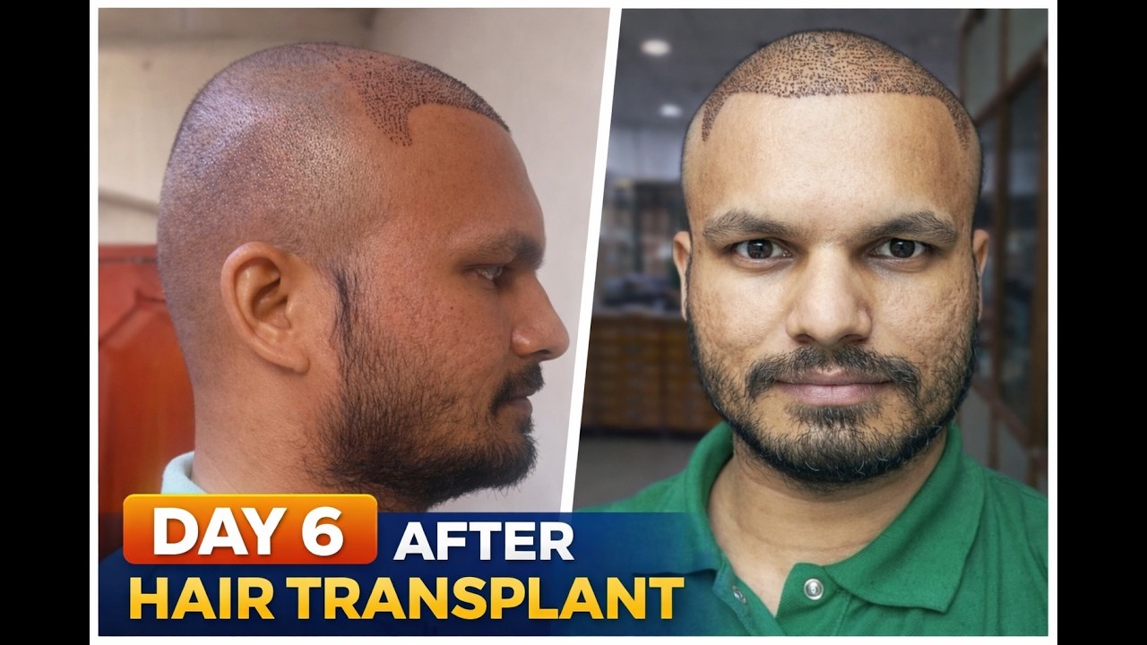 Hair Transplant Day 6 Update | Scalp Healing & Hairline Result 😲#hairtransplant #naturalhairline