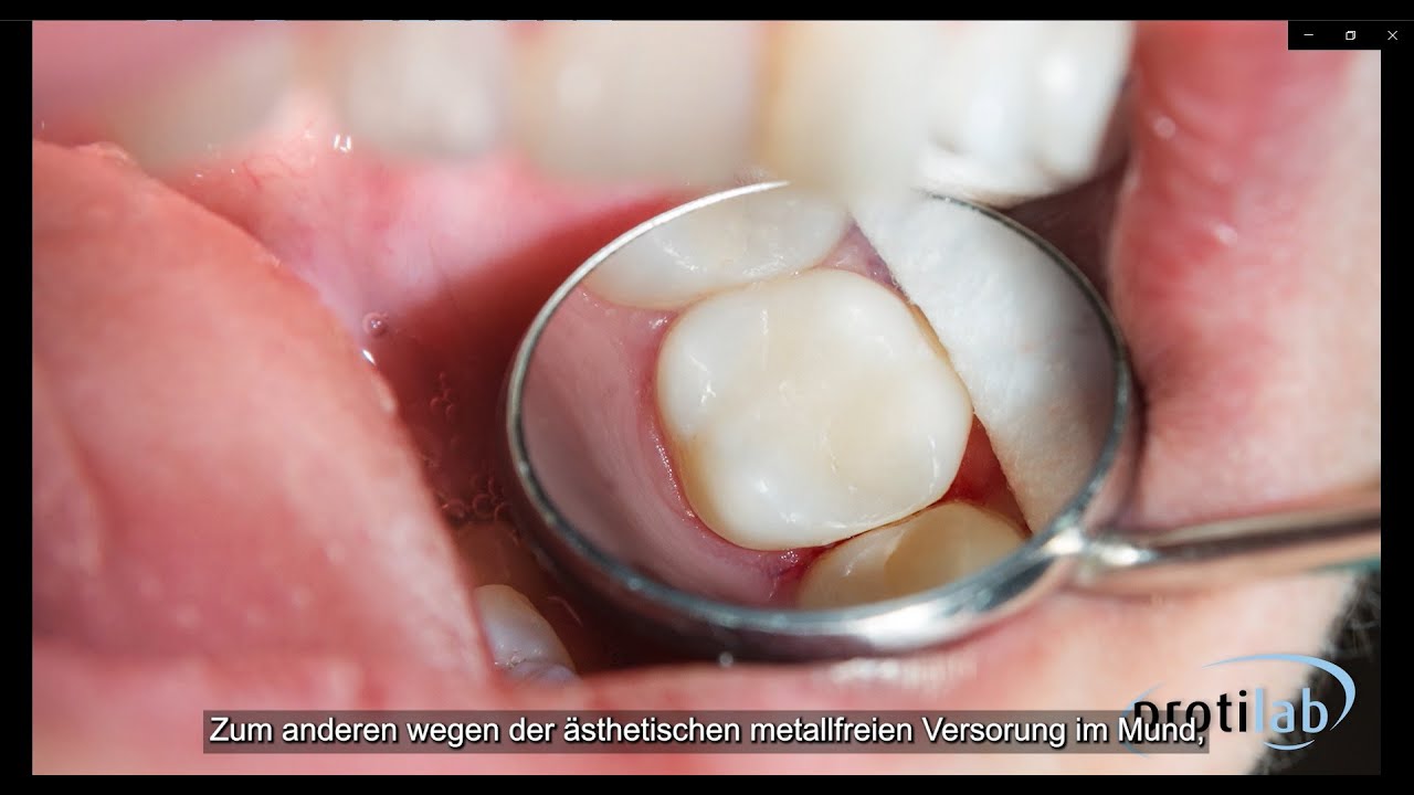 Produktratgeber: Vollverblendete / Geschichtete Keramik