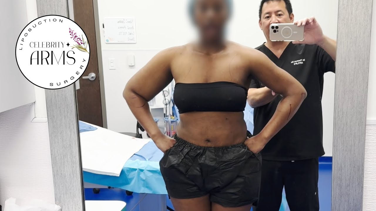 ⚠️ The Truth About Arm Liposuction: What Surgeons Aren&rsquo;t Telling You 😳 | Celebrity Arms&trade; Liposuction