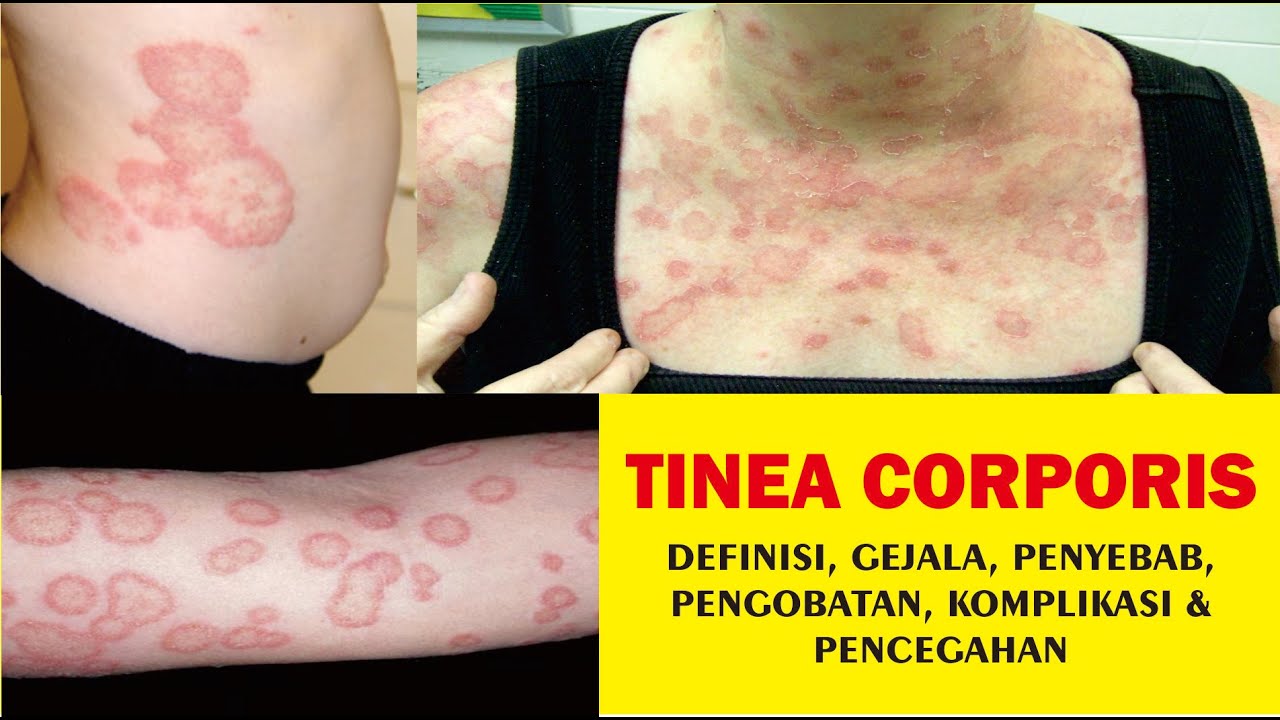 TINEA CORPORIS, Definisi, Gejala, Penyebab, Pengobatan, Komplikasi dan Pencegahan
