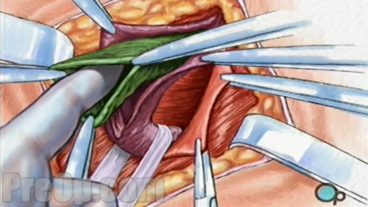 Обучение пациентов по паховой (открытой) грыжесечению