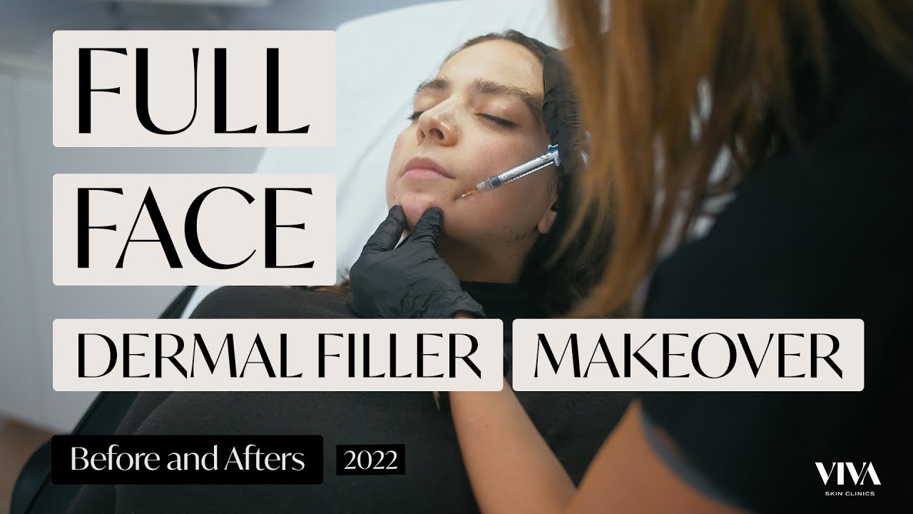 FULL FACE Dermal Filler Makeover | Before & Afters | VIVA Skin Clinics (2022)