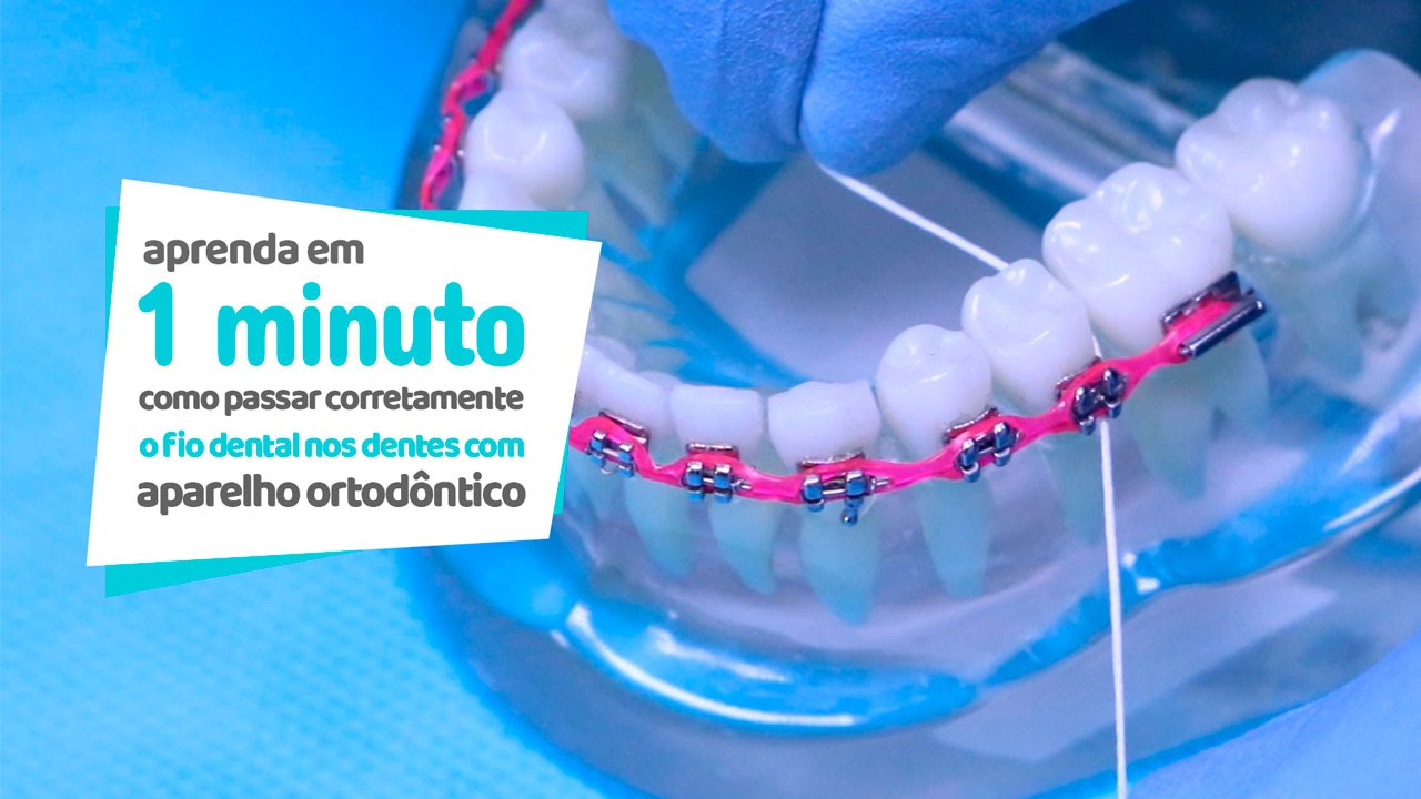 Como passar corretamente o fio dental em dentes com aparelho ortodôntico - Cir Hospital Odontológico