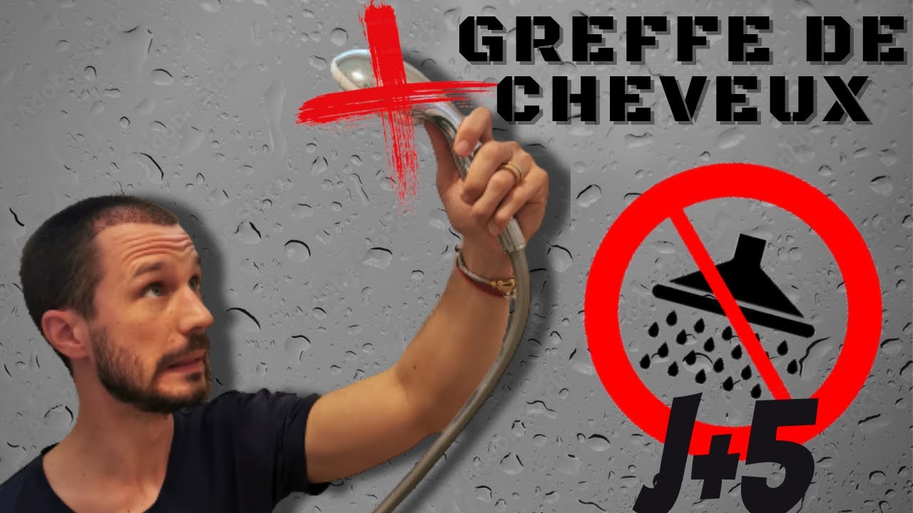 Comment se laver les cheveux suite à Ma GREFFE DHI J+5