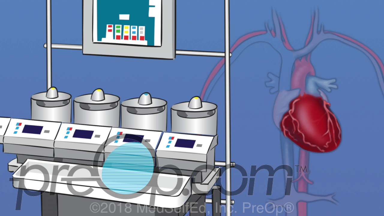 Coronary Artery Bypass Graft (CABG) Surgery - PreOp&reg; Patient Education