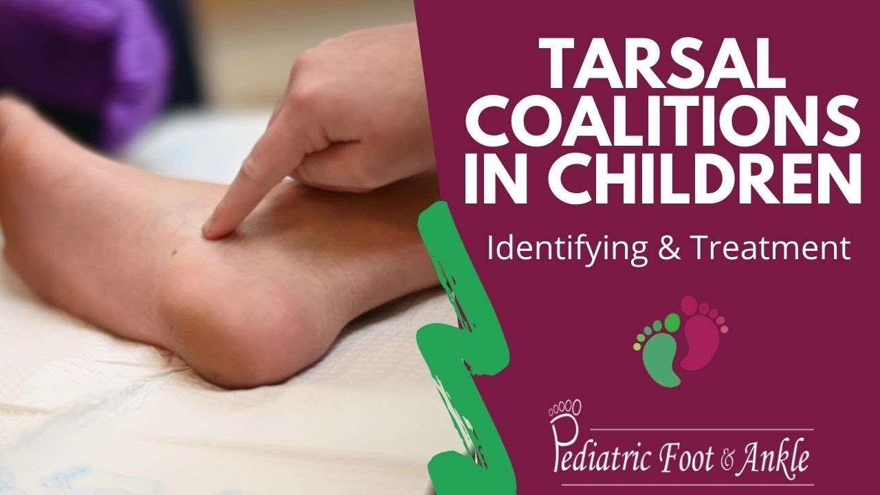 Identifying & Treating Tarsal Coalitions in Children