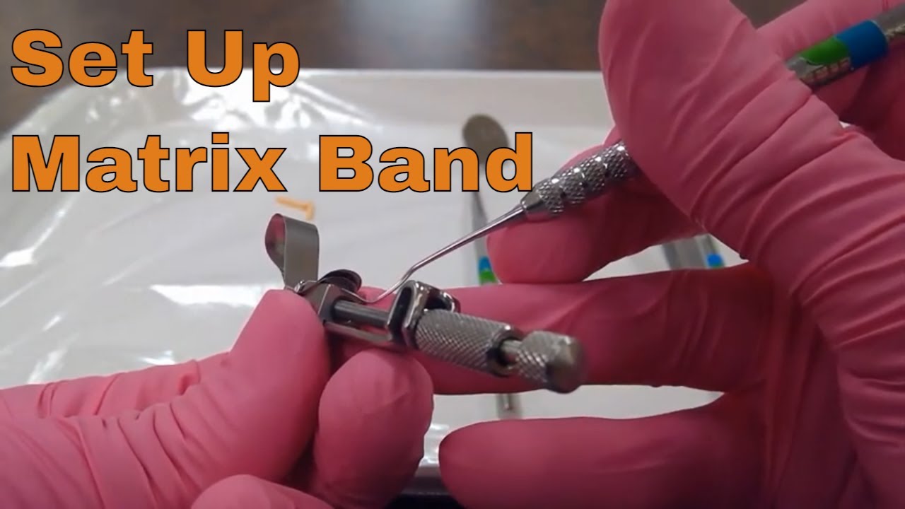 Tofflemire Matrix - Wrap That Tooth Up