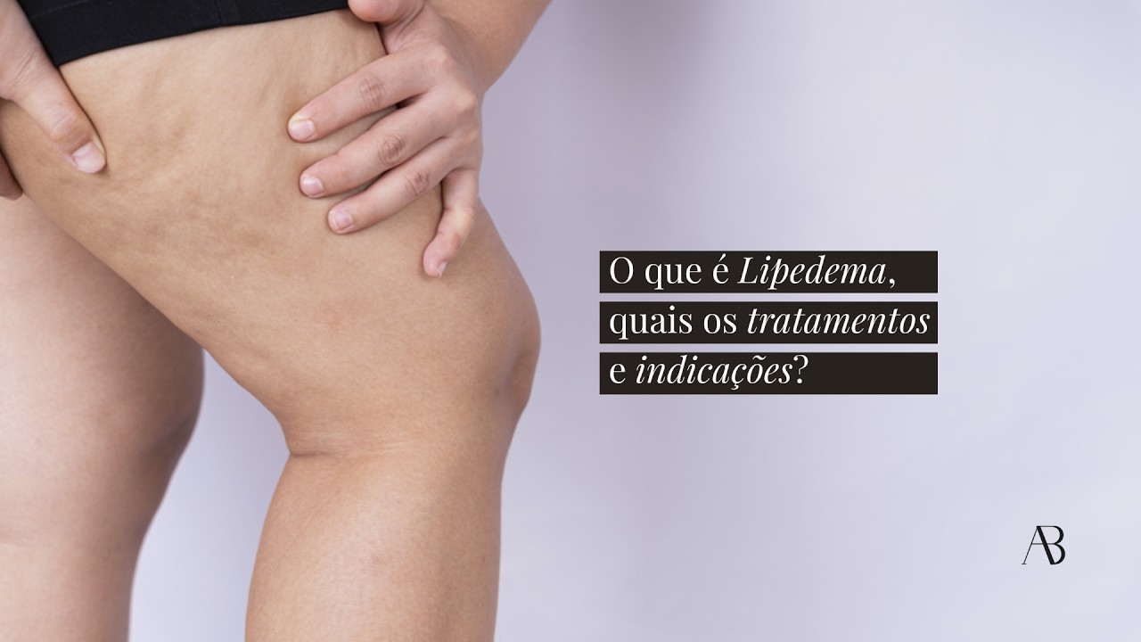O que é lipedema? Entenda a condição e como a Vibrolipoaspiração Metabólica pode ajudar!