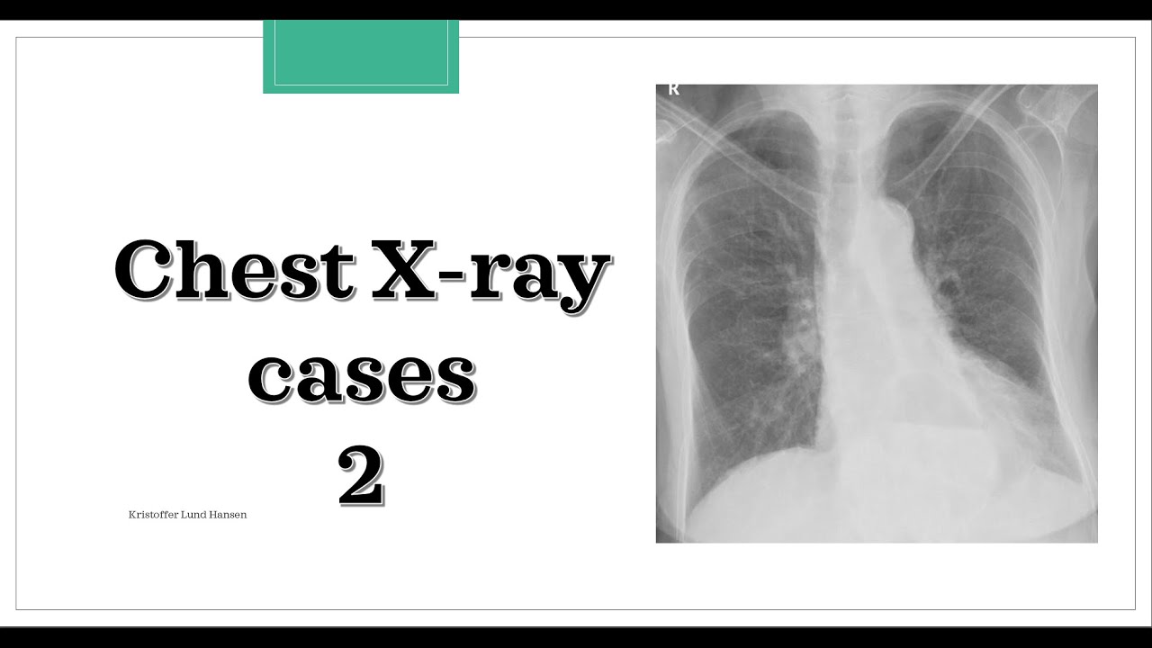 Chest X-ray cases 2 - with explanation