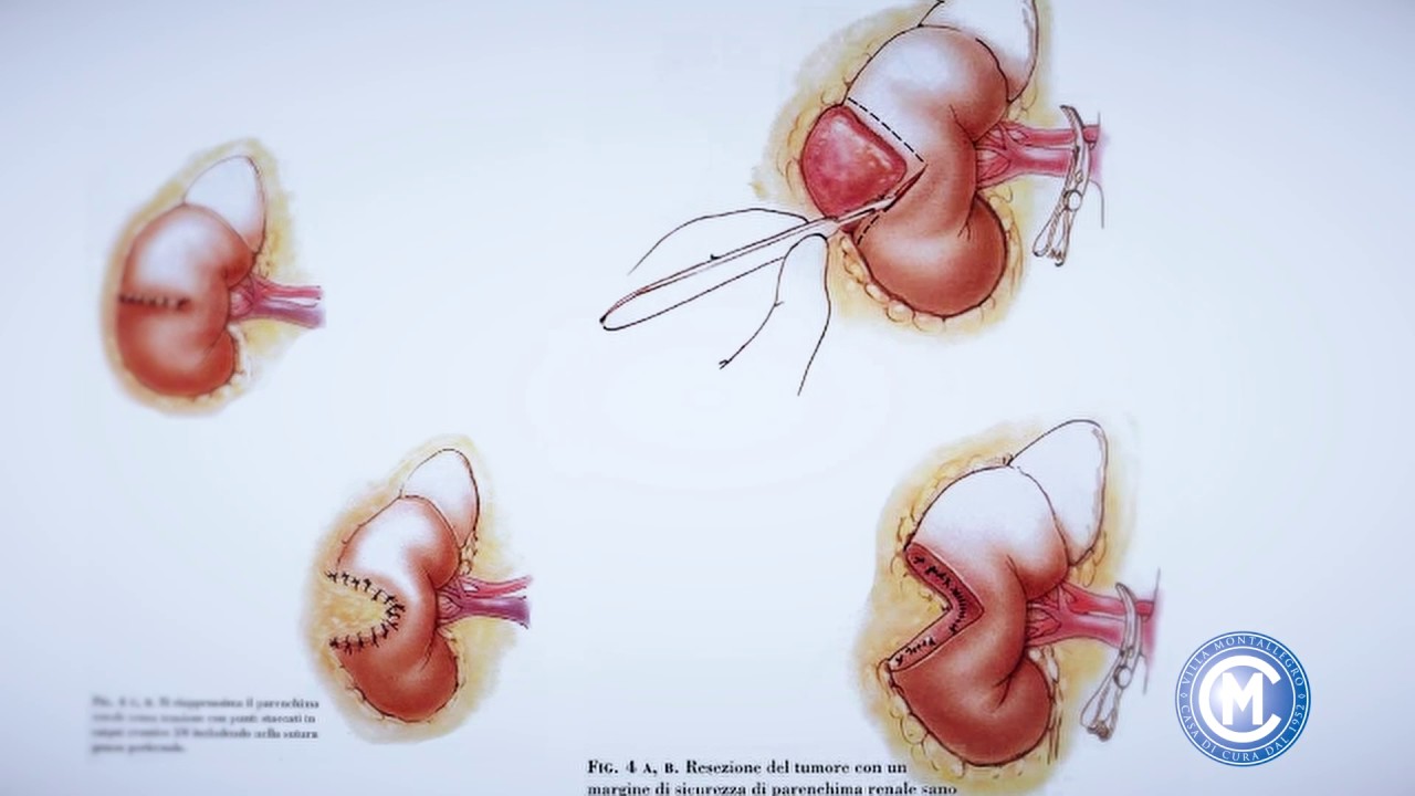 Paolo Puppo - Chirurgia conservativa del rene (tumorectomia)
