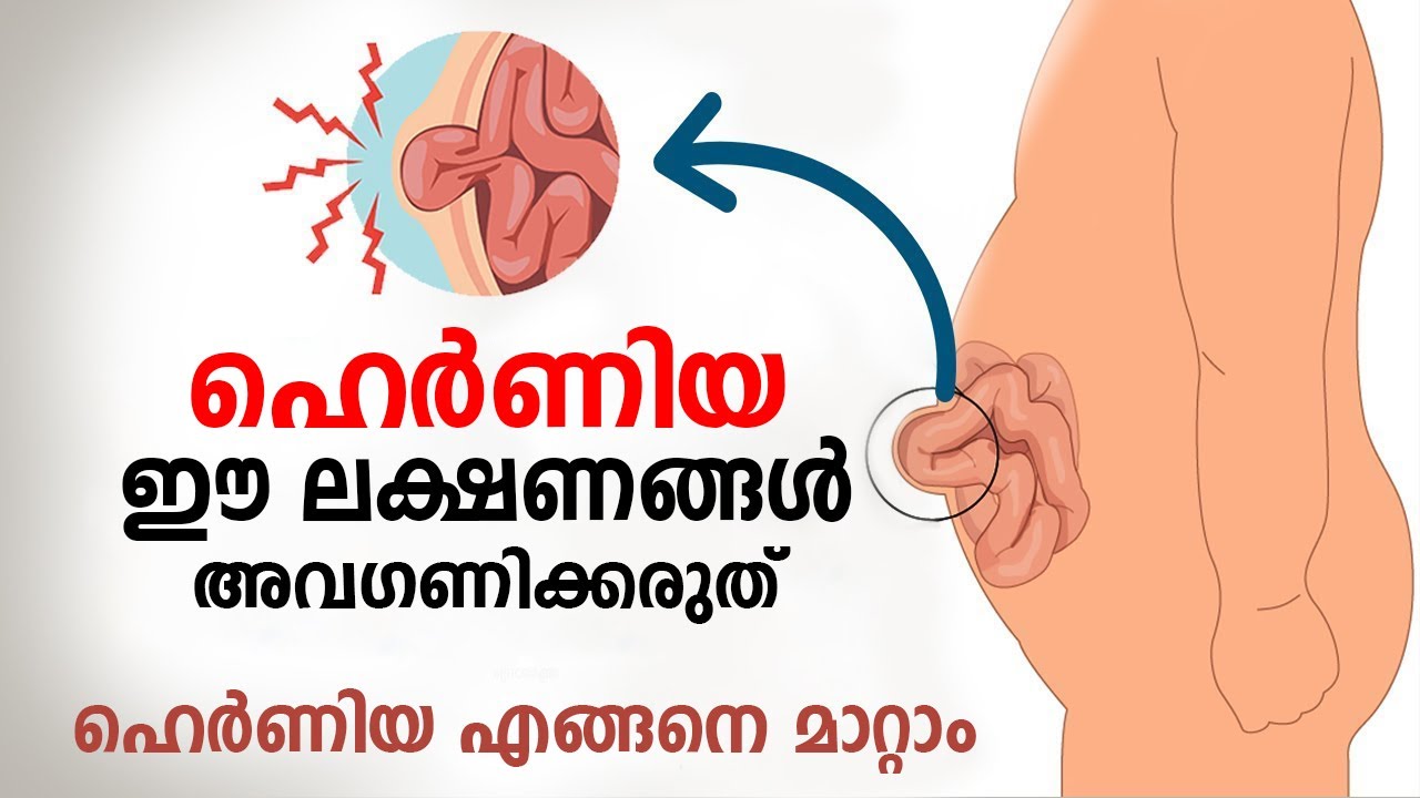 ഹെർണിയ രോഗത്തിന്റെ ഈ ലക്ഷണങ്ങൾ അവഗണിക്കരുത് | Hernia Malayalam | Hernia Symptoms