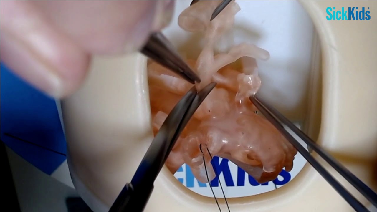 HOST - Arterial Switch Operation (Open Technique) performed on a 3D model - Dr David J Barron (FULL)