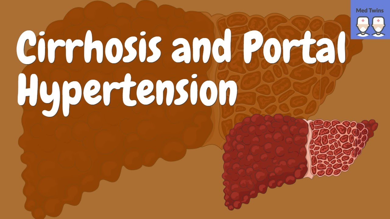 Cirrhosis and Portal Hypertension [Pathophysiology, Signs and Symptoms, Complication, Ascites]