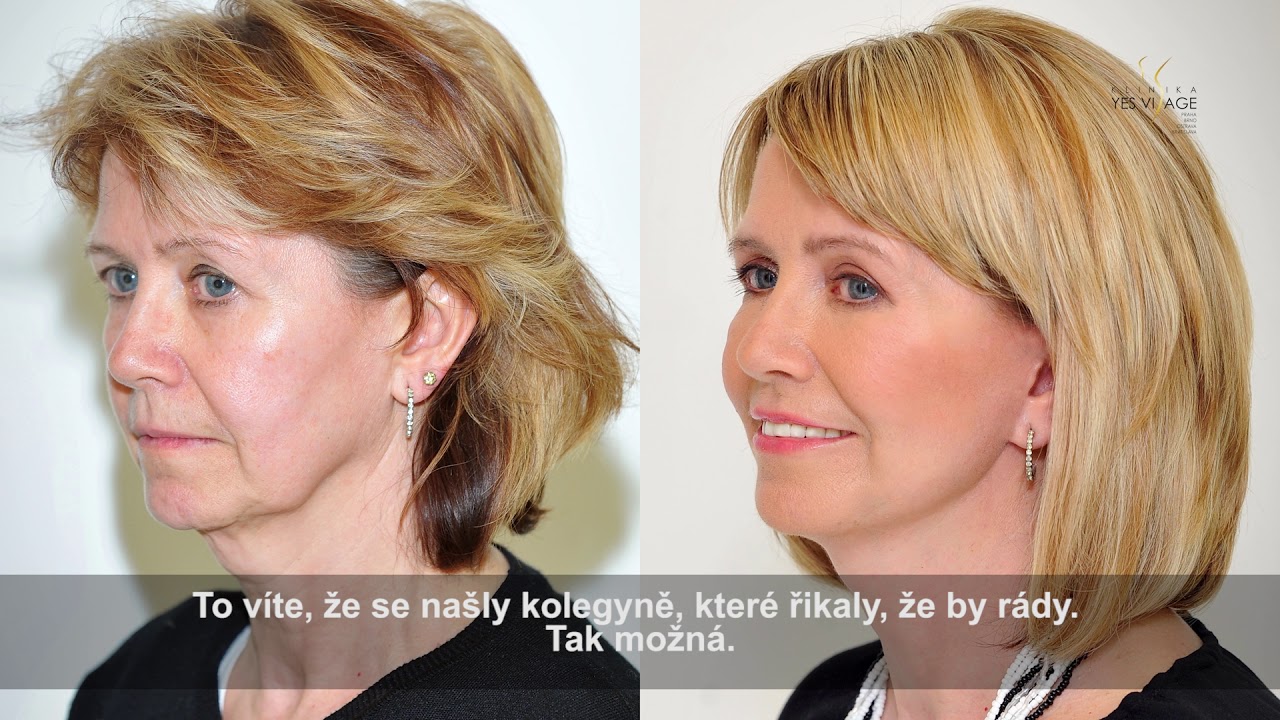 Facelift obličeje a krku a plastika horních víček